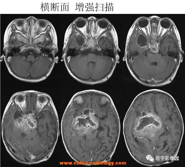 【病例】鞍区毛细胞型星形细胞瘤1例CT及MR 【病例】鞍区毛细胞型星形细胞瘤1例CT及MR