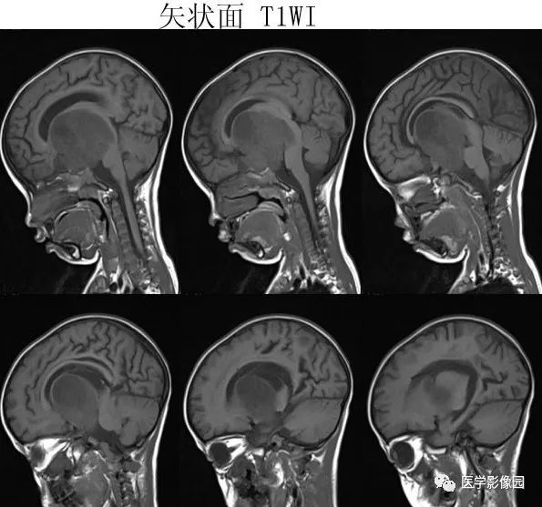 【病例】鞍区毛细胞型星形细胞瘤1例CT及MR 【病例】鞍区毛细胞型星形细胞瘤1例CT及MR