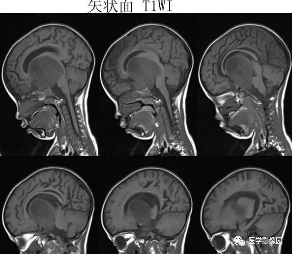 【病例】鞍区毛细胞型星形细胞瘤1例CT及MR 【病例】鞍区毛细胞型星形细胞瘤1例CT及MR