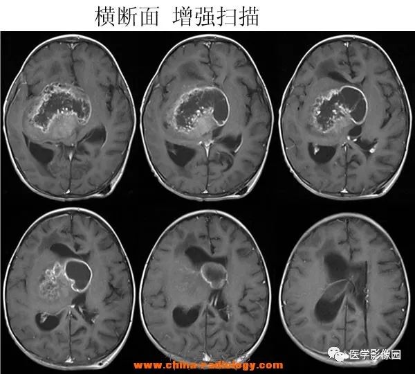 【病例】鞍区毛细胞型星形细胞瘤1例CT及MR 【病例】鞍区毛细胞型星形细胞瘤1例CT及MR