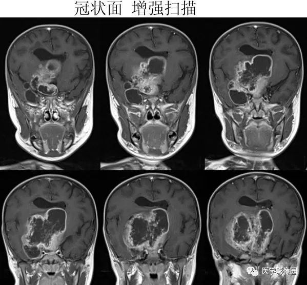 【病例】鞍区毛细胞型星形细胞瘤1例CT及MR 【病例】鞍区毛细胞型星形细胞瘤1例CT及MR