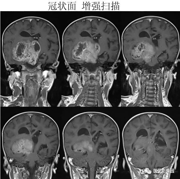 【病例】鞍区毛细胞型星形细胞瘤1例CT及MR 【病例】鞍区毛细胞型星形细胞瘤1例CT及MR