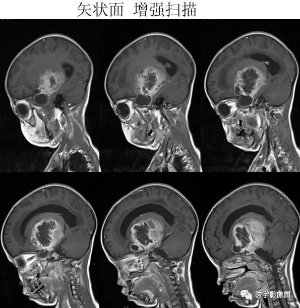 【病例】鞍区毛细胞型星形细胞瘤1例CT及MR 【病例】鞍区毛细胞型星形细胞瘤1例CT及MR