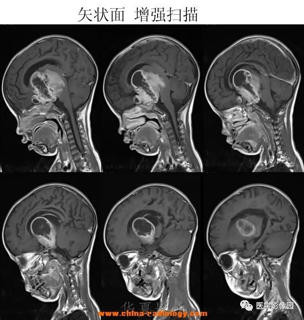 【病例】鞍区毛细胞型星形细胞瘤1例CT及MR 【病例】鞍区毛细胞型星形细胞瘤1例CT及MR