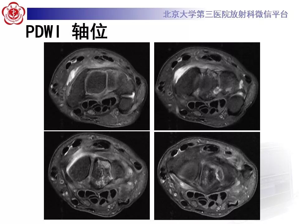 【病例】月骨缺血性坏死/无菌性坏死1例MR