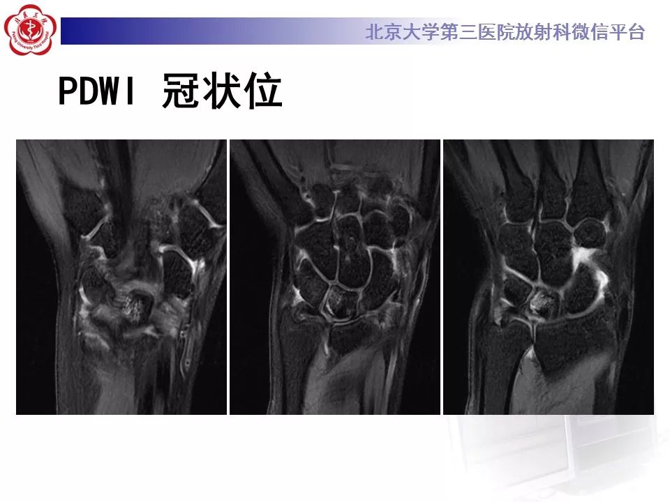 【病例】月骨缺血性坏死/无菌性坏死1例MR