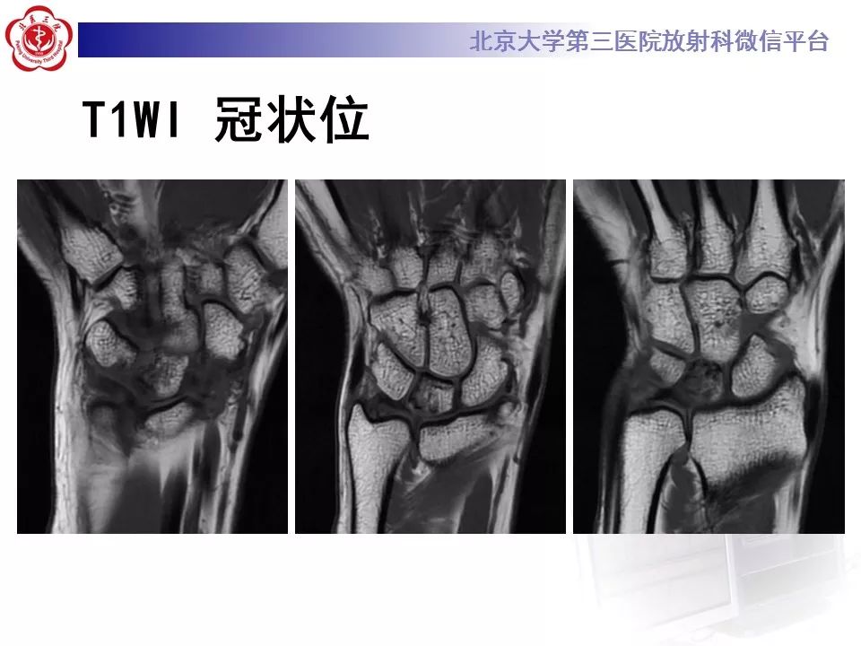 【病例】月骨缺血性坏死/无菌性坏死1例MR