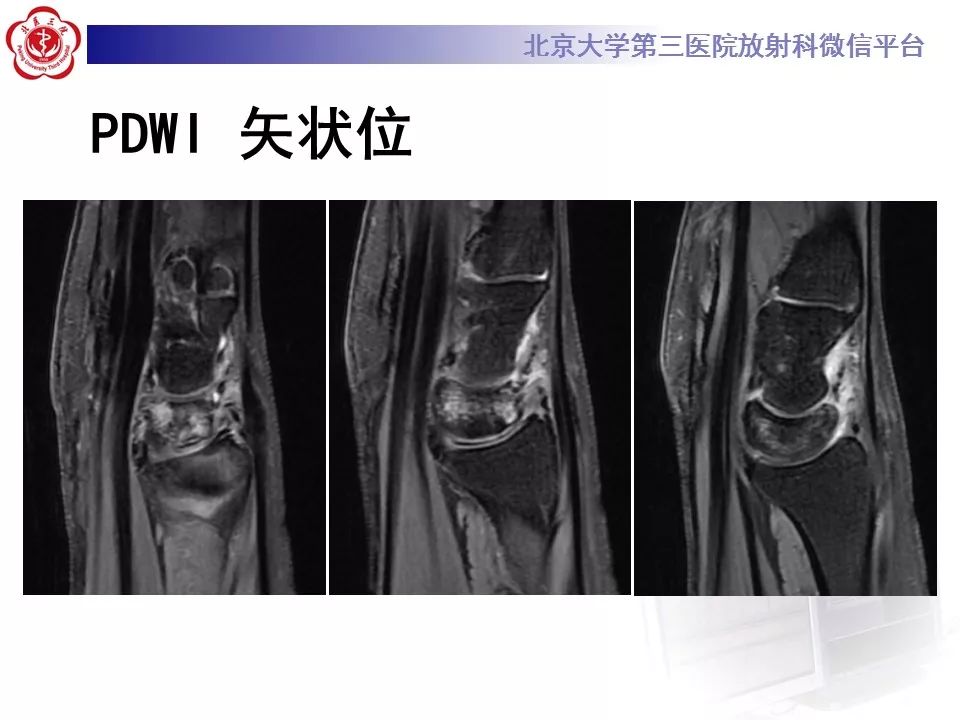 【病例】月骨缺血性坏死/无菌性坏死1例MR