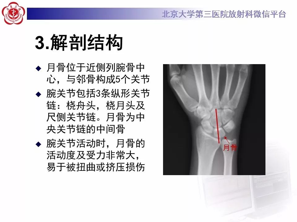 【病例】月骨缺血性坏死/无菌性坏死1例MR