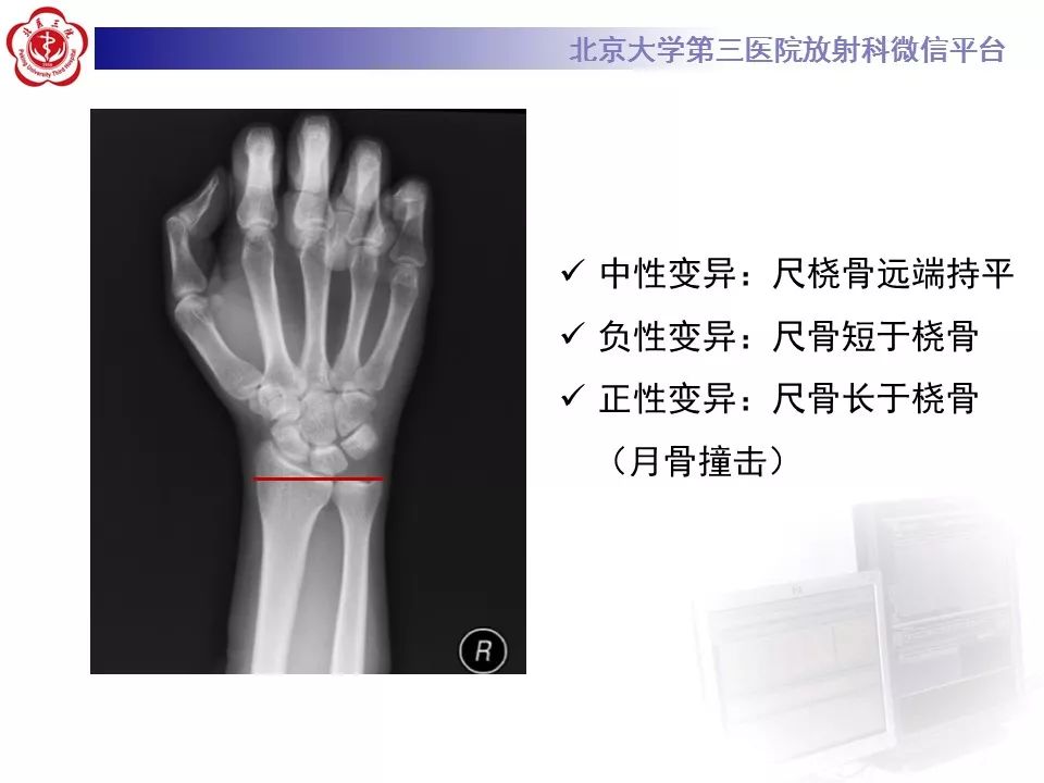 【病例】月骨缺血性坏死/无菌性坏死1例MR