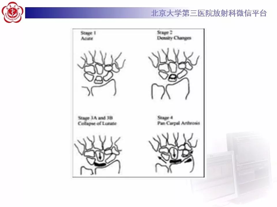 【病例】月骨缺血性坏死/无菌性坏死1例MR
