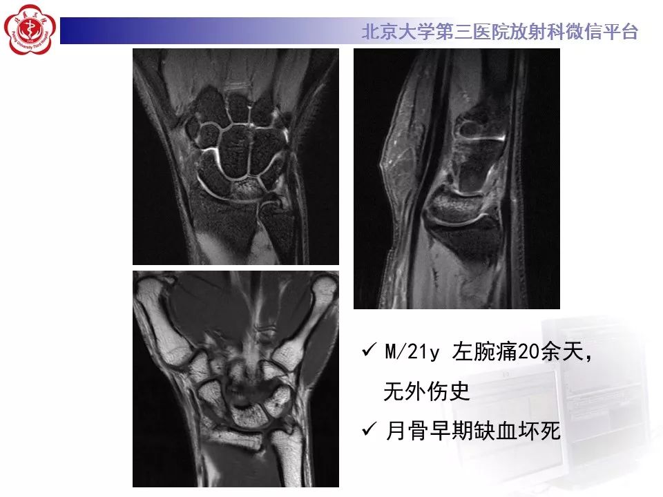 【病例】月骨缺血性坏死/无菌性坏死1例MR