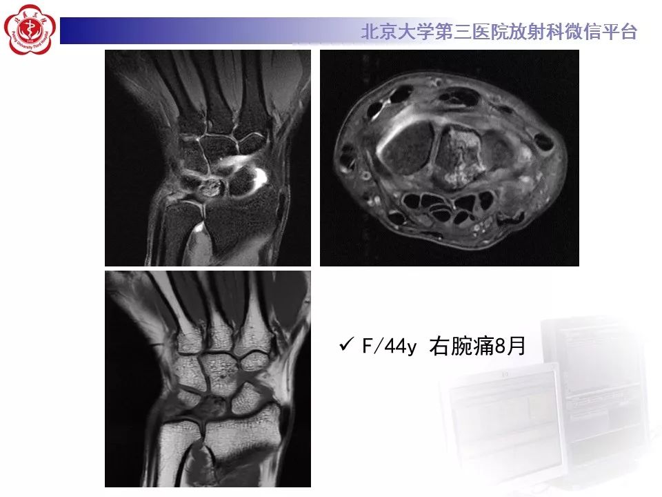 【病例】月骨缺血性坏死/无菌性坏死1例MR