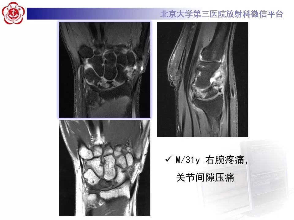 【病例】月骨缺血性坏死/无菌性坏死1例MR