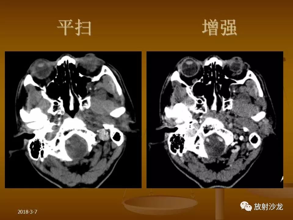 【PPT】腮腺区肿块的诊断与鉴别诊断