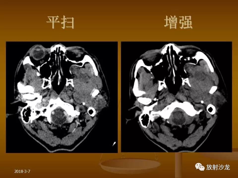 【PPT】腮腺区肿块的诊断与鉴别诊断