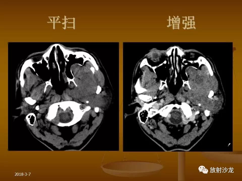 【PPT】腮腺区肿块的诊断与鉴别诊断