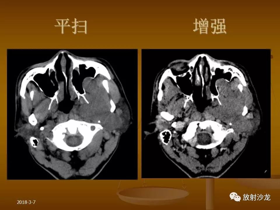 【PPT】腮腺区肿块的诊断与鉴别诊断