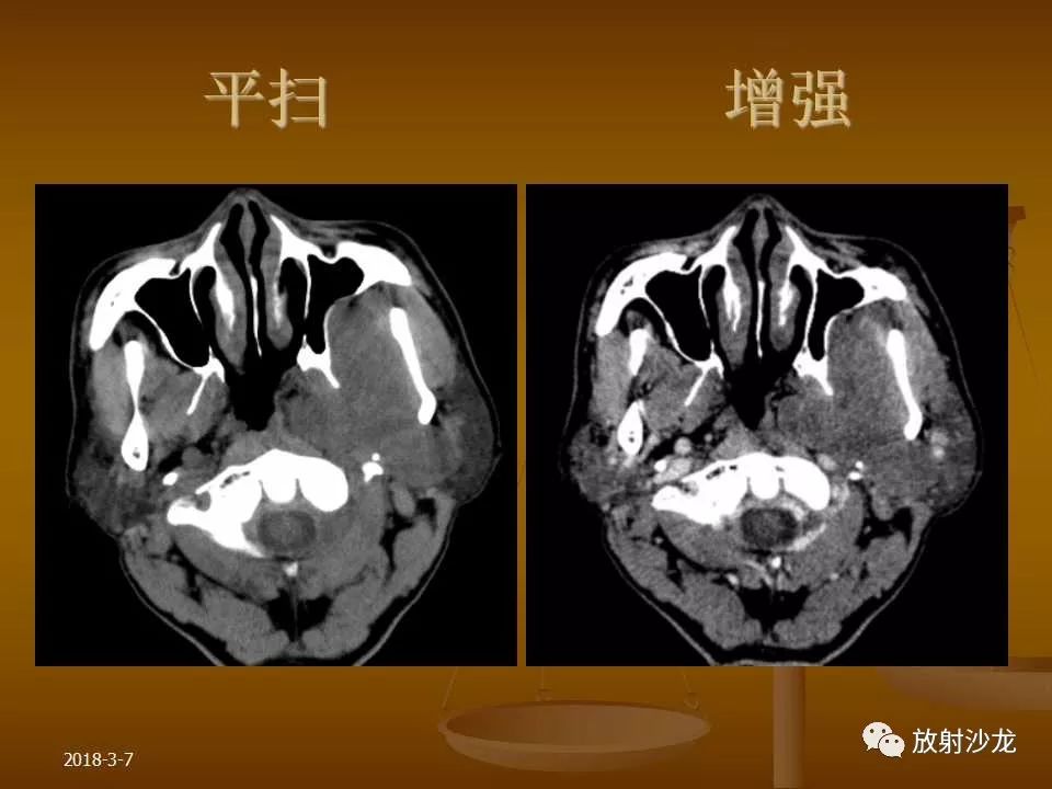 【PPT】腮腺区肿块的诊断与鉴别诊断