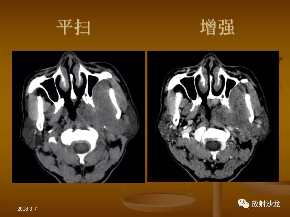 【PPT】腮腺区肿块的诊断与鉴别诊断
