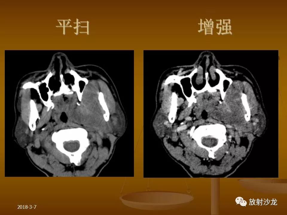 【PPT】腮腺区肿块的诊断与鉴别诊断