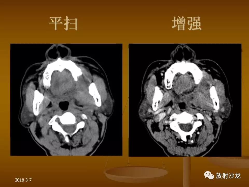 【PPT】腮腺区肿块的诊断与鉴别诊断