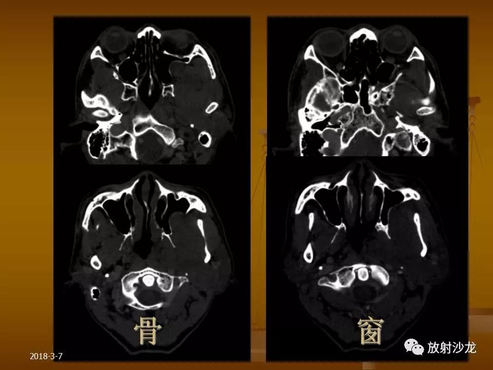 【PPT】腮腺区肿块的诊断与鉴别诊断