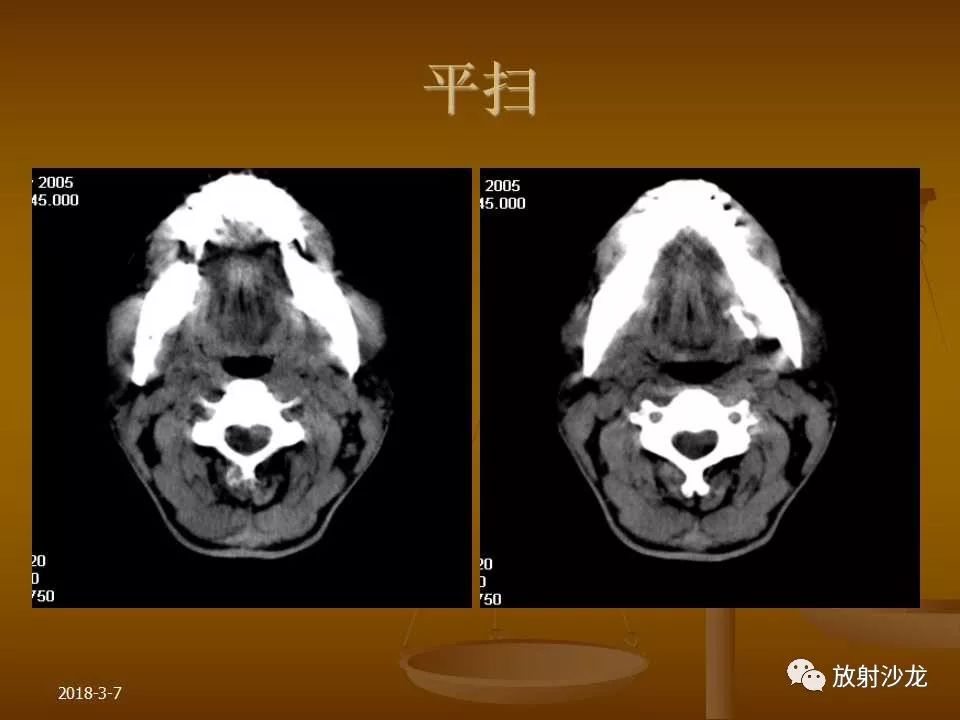 【PPT】腮腺区肿块的诊断与鉴别诊断