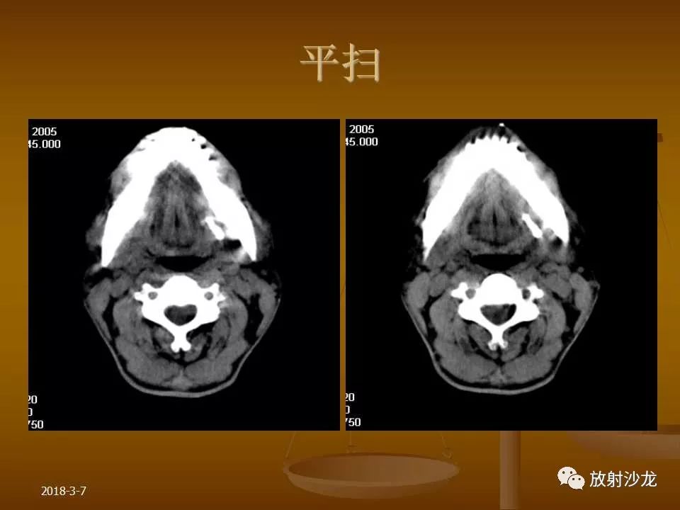 【PPT】腮腺区肿块的诊断与鉴别诊断