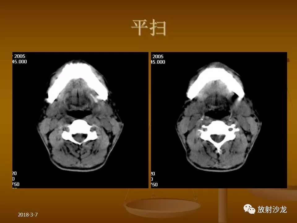 【PPT】腮腺区肿块的诊断与鉴别诊断