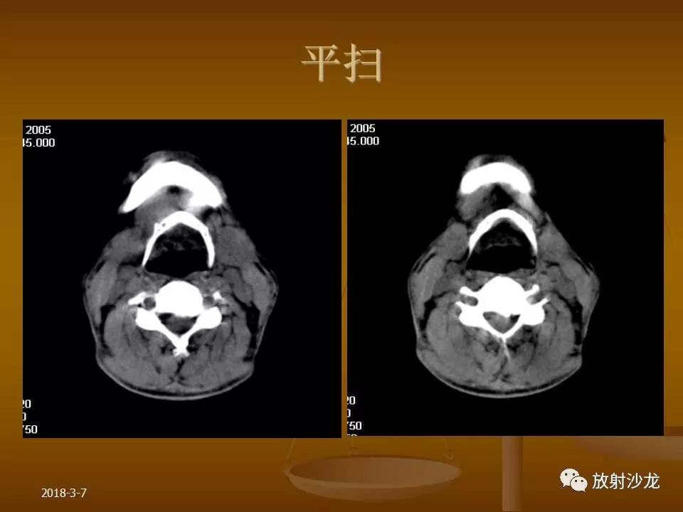 【PPT】腮腺区肿块的诊断与鉴别诊断
