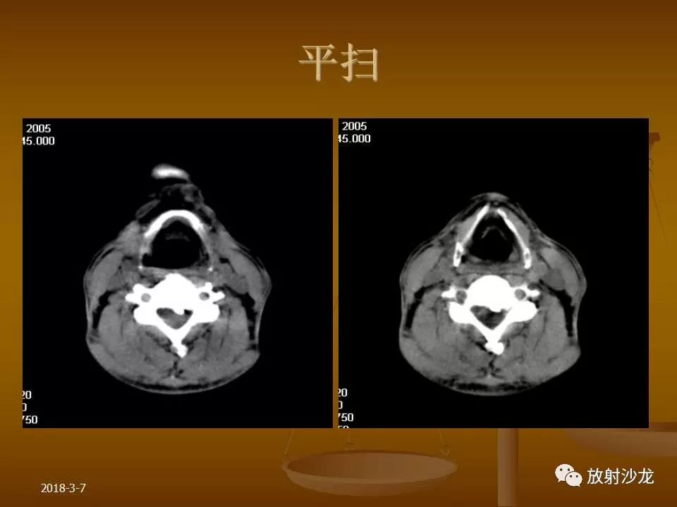 【PPT】腮腺区肿块的诊断与鉴别诊断