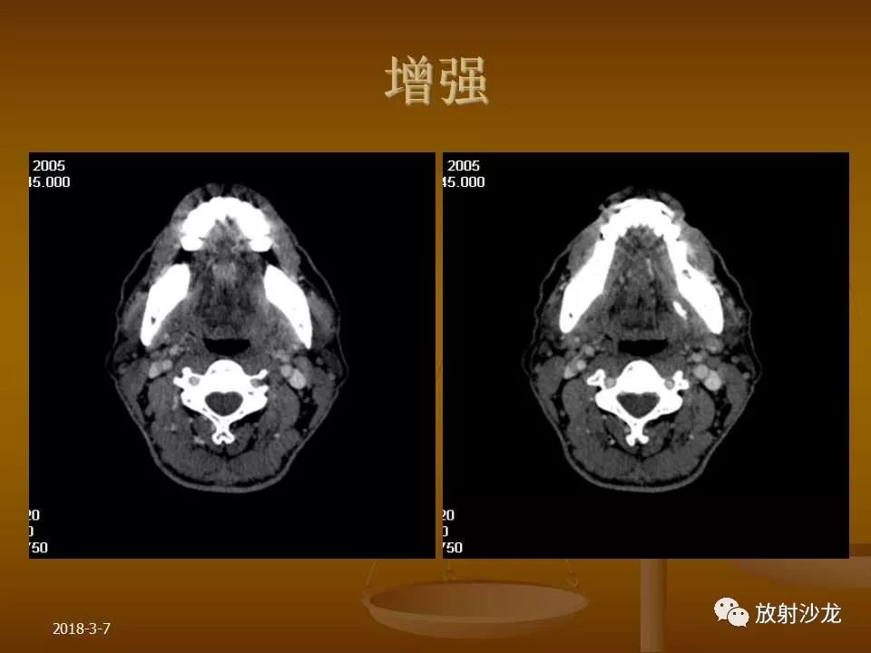 【PPT】腮腺区肿块的诊断与鉴别诊断