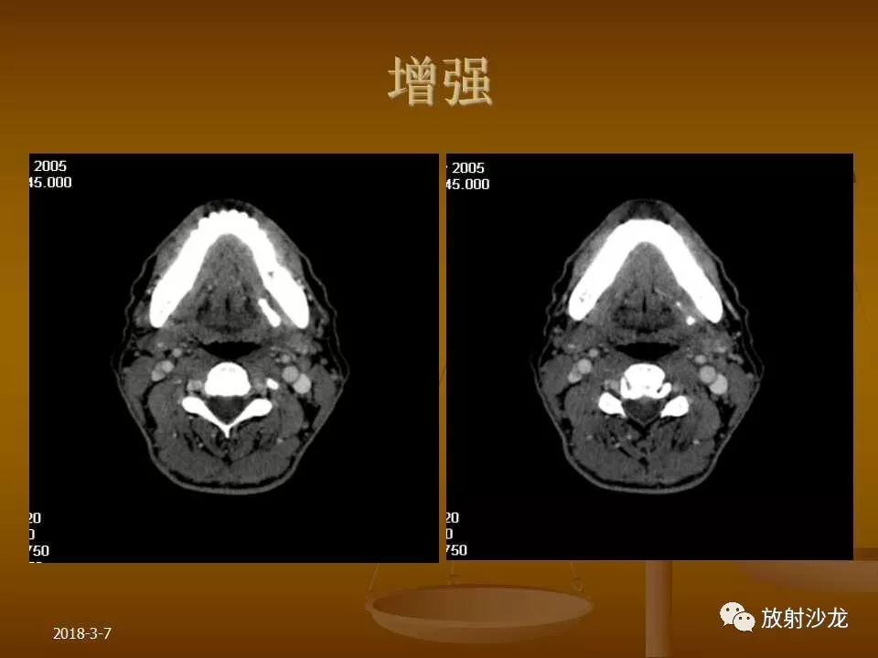 【PPT】腮腺区肿块的诊断与鉴别诊断