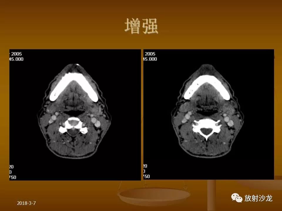 【PPT】腮腺区肿块的诊断与鉴别诊断