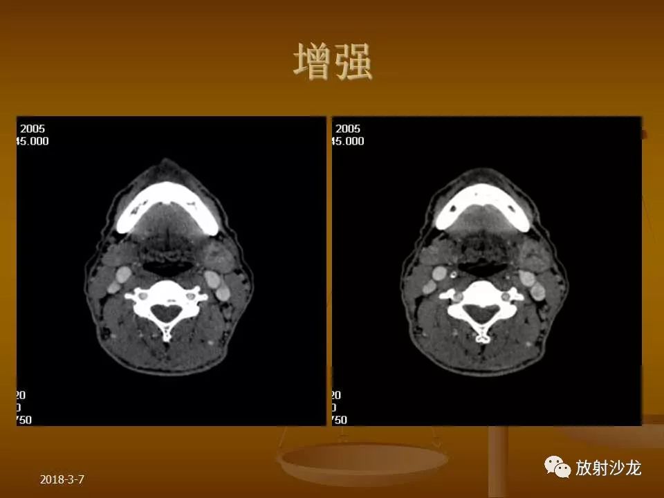 【PPT】腮腺区肿块的诊断与鉴别诊断