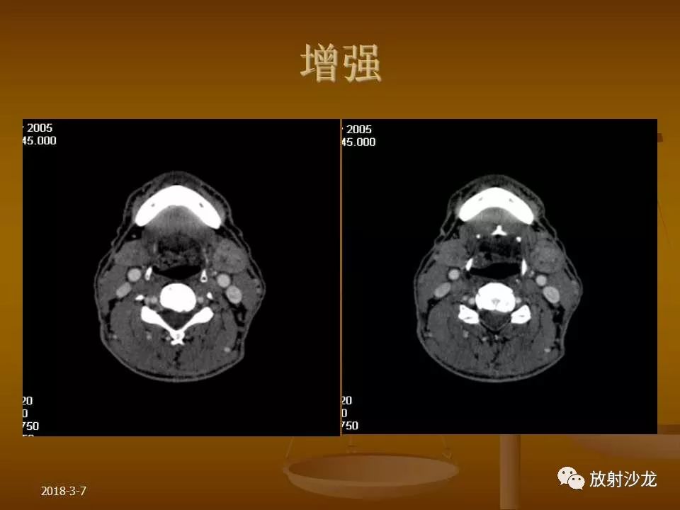 【PPT】腮腺区肿块的诊断与鉴别诊断