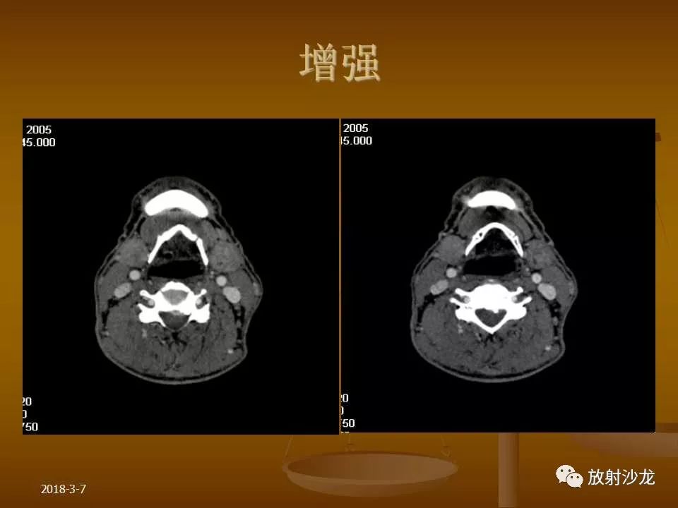 【PPT】腮腺区肿块的诊断与鉴别诊断