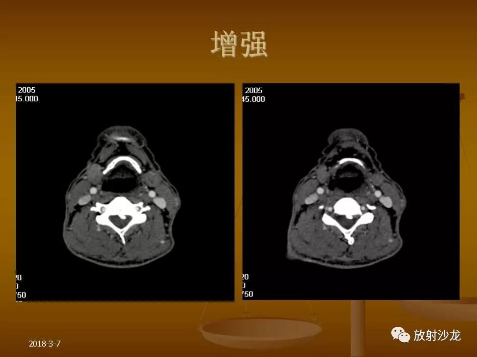 【PPT】腮腺区肿块的诊断与鉴别诊断