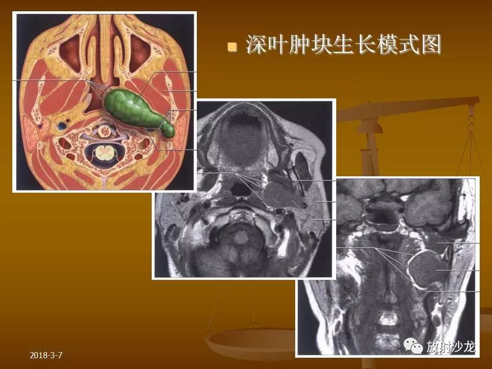 【PPT】腮腺区肿块的诊断与鉴别诊断