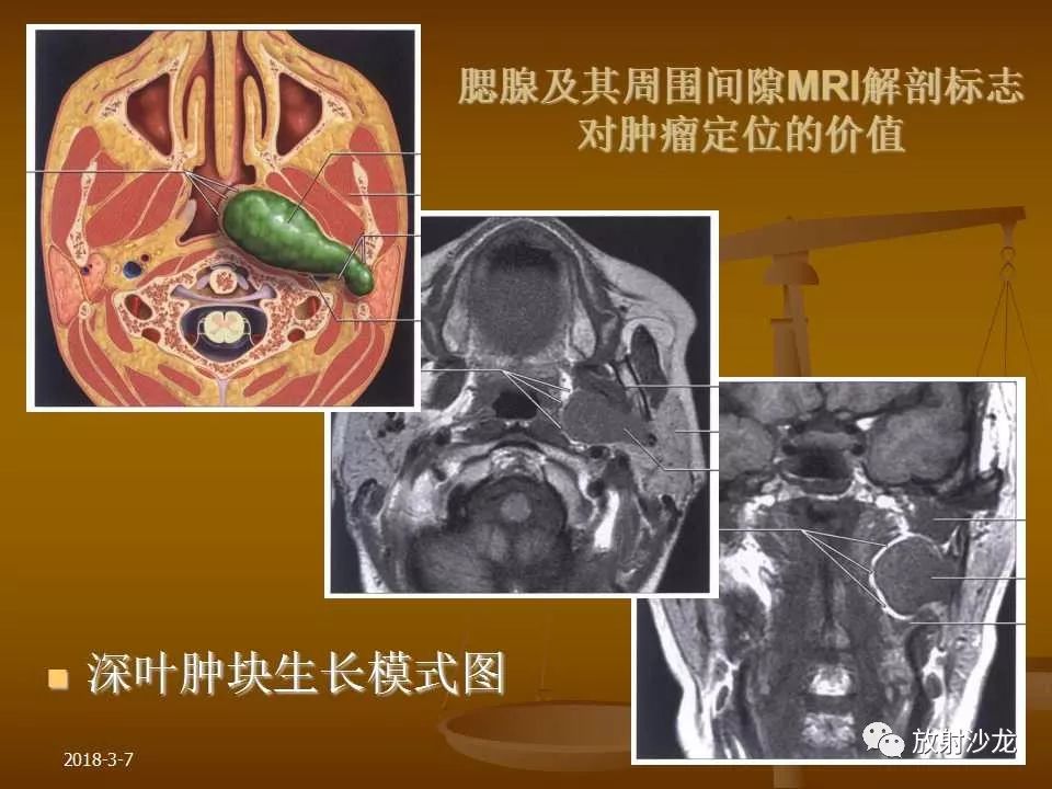 【PPT】腮腺区肿块的诊断与鉴别诊断