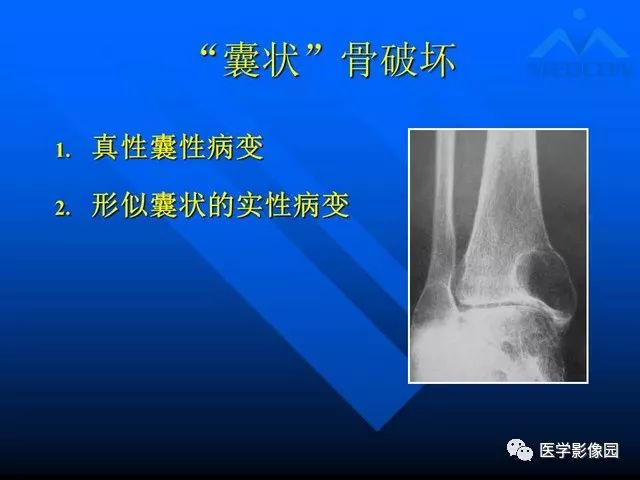 【PPT】关节周围那些囊状骨破坏的诊断与鉴别