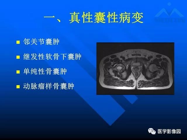【PPT】关节周围那些囊状骨破坏的诊断与鉴别
