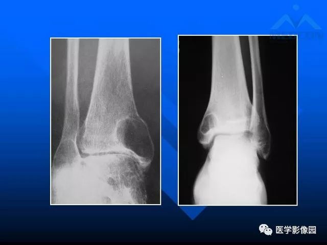【PPT】关节周围那些囊状骨破坏的诊断与鉴别