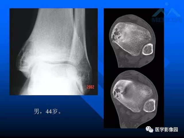 【PPT】关节周围那些囊状骨破坏的诊断与鉴别