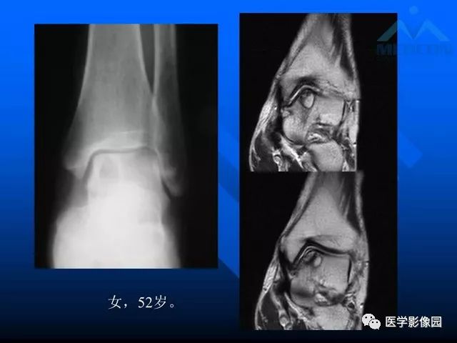 【PPT】关节周围那些囊状骨破坏的诊断与鉴别