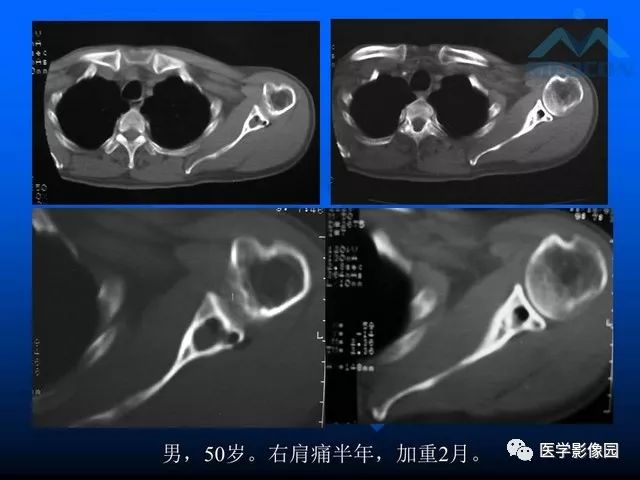 【PPT】关节周围那些囊状骨破坏的诊断与鉴别