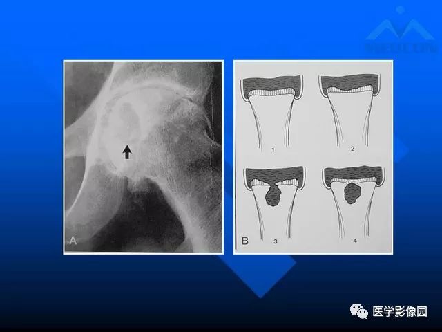 【PPT】关节周围那些囊状骨破坏的诊断与鉴别