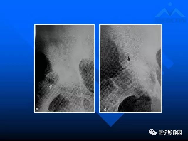 【PPT】关节周围那些囊状骨破坏的诊断与鉴别