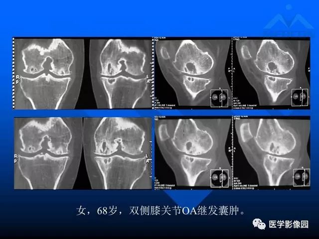 【PPT】关节周围那些囊状骨破坏的诊断与鉴别